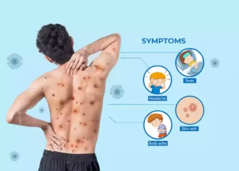 মাঙ্কি পক্স সম্পর্কিত গাইড লাইন প্রকাশ কেন্দ্রের, জানুন বিস্তারিত