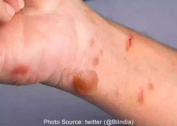 TomatoFlu cases spread to Haryana, Tamil Nadu and Odisha