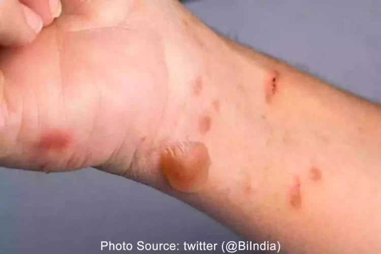 TomatoFlu cases spread to Haryana, Tamil Nadu and Odisha